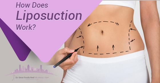 does liposuction 